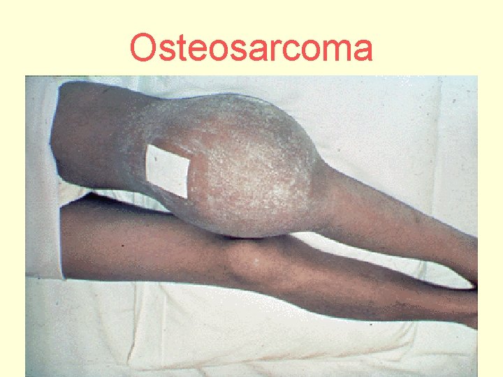 Osteosarcoma 
