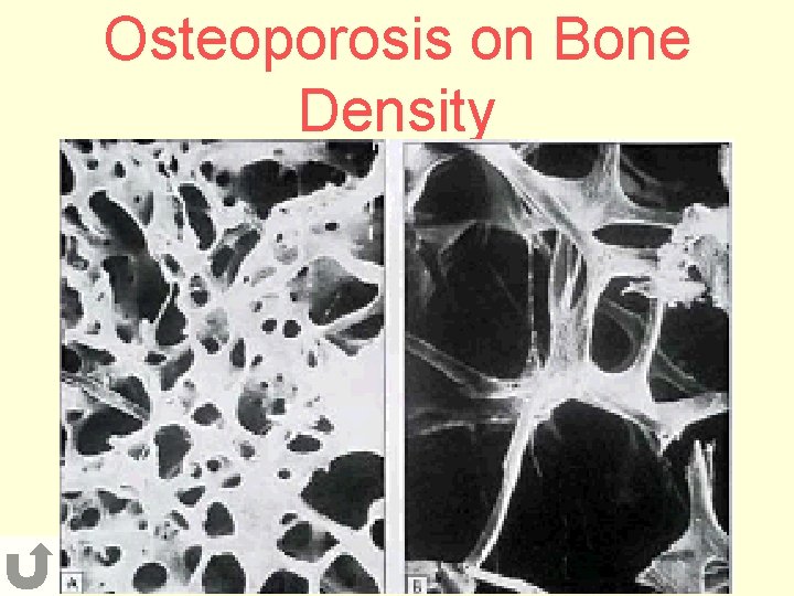 Osteoporosis on Bone Density 