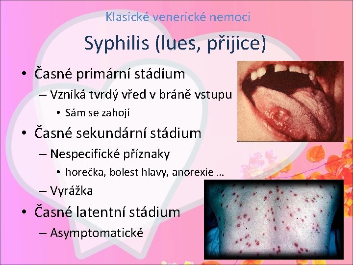 Klasické venerické nemoci Syphilis (lues, přijice) • Časné primární stádium – Vzniká tvrdý vřed