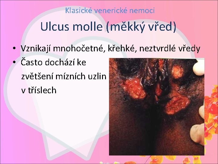 Klasické venerické nemoci Ulcus molle (měkký vřed) • Vznikají mnohočetné, křehké, neztvrdlé vředy •