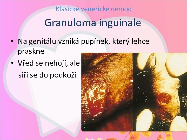 Klasické venerické nemoci Granuloma inguinale • Na genitálu vzniká pupínek, který lehce praskne •