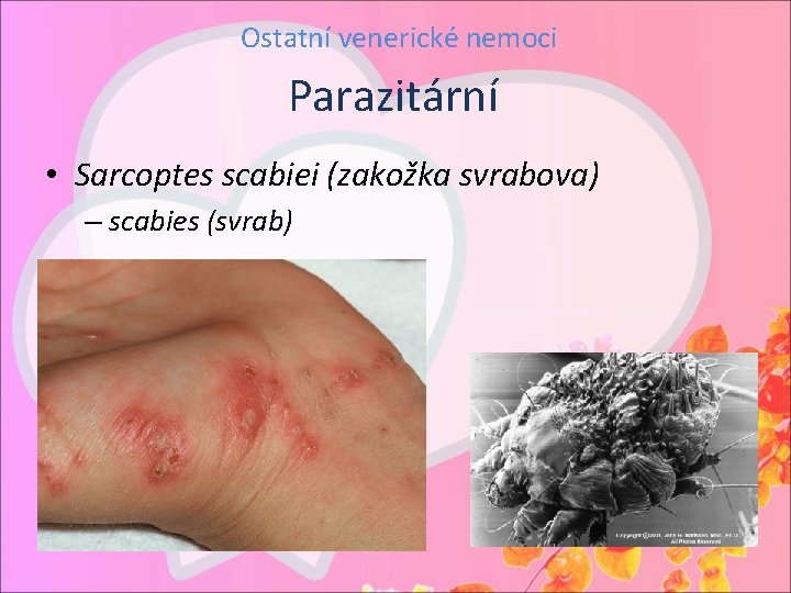Ostatní venerické nemoci Parazitární • Sarcoptes scabiei (zakožka svrabova) – scabies (svrab) 