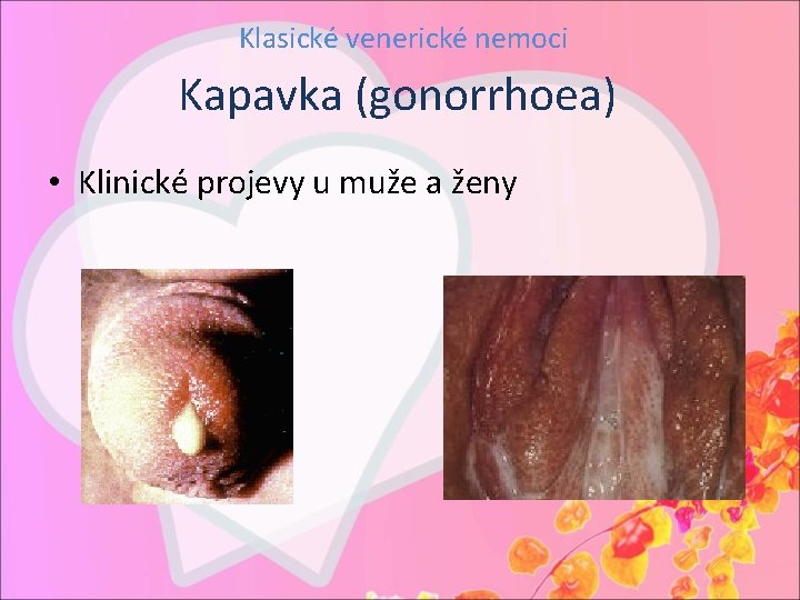 Klasické venerické nemoci Kapavka (gonorrhoea) • Klinické projevy u muže a ženy 