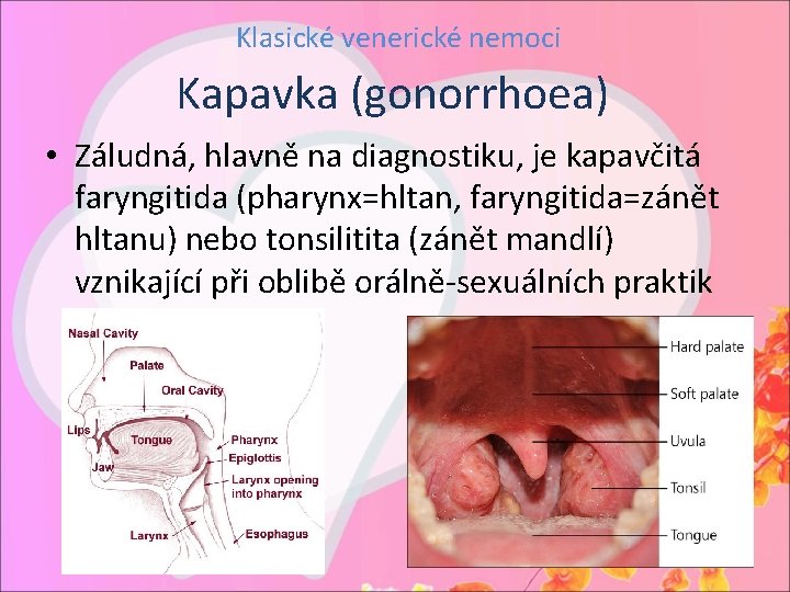 Klasické venerické nemoci Kapavka (gonorrhoea) • Záludná, hlavně na diagnostiku, je kapavčitá faryngitida (pharynx=hltan,