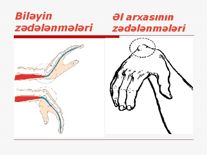 Biləyin zədələnmələri Əl arxasının zədələnmələri 