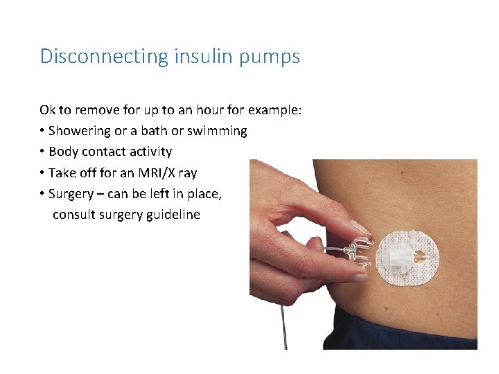 Disconnecting insulin pumps Ok to remove for up to an hour for example: •
