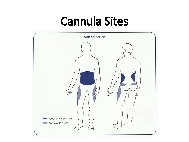 Cannula Sites 
