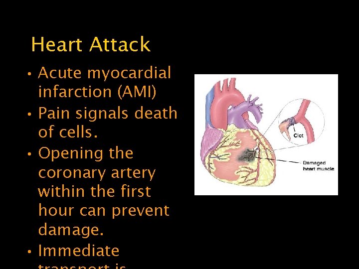 Heart Attack • Acute myocardial infarction (AMI) • Pain signals death of cells. •