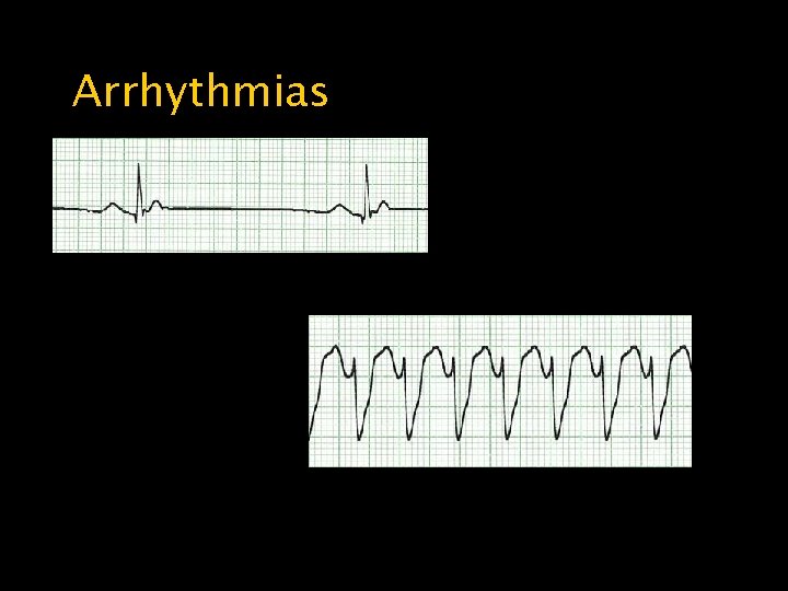 Arrhythmias Bradycardia Ventricular Tachycardia 