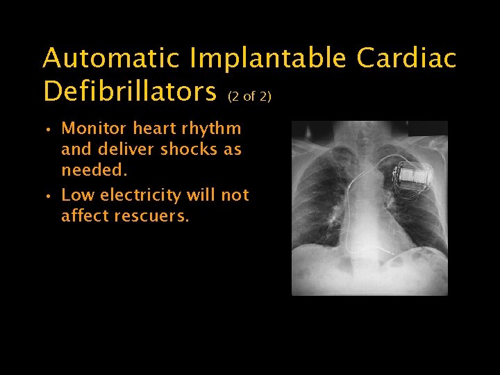 Automatic Implantable Cardiac Defibrillators (2 of 2) • Monitor heart rhythm and deliver shocks