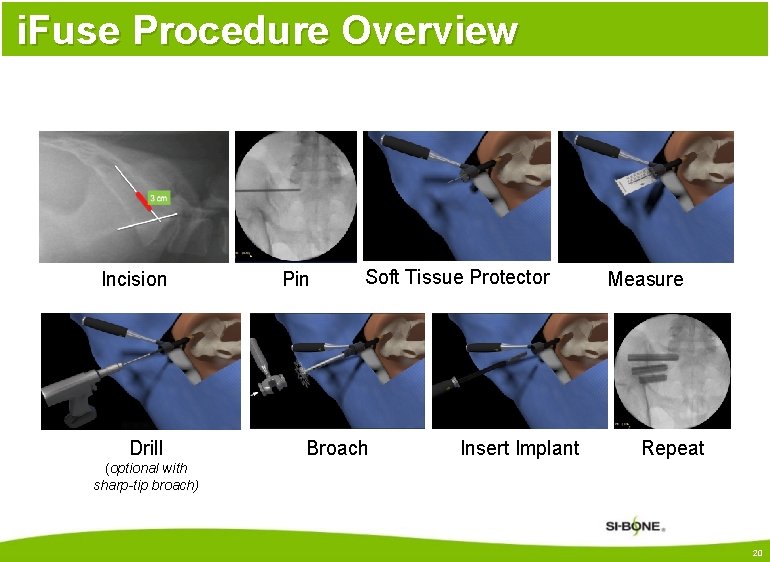 i. Fuse Procedure Overview Incision Drill Pin Soft Tissue Protector Broach Insert Implant Measure
