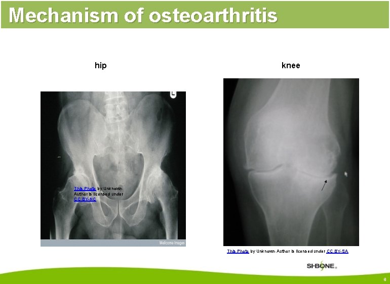 Mechanism of osteoarthritis hip knee This Photo by Unknown Author is licensed under CC