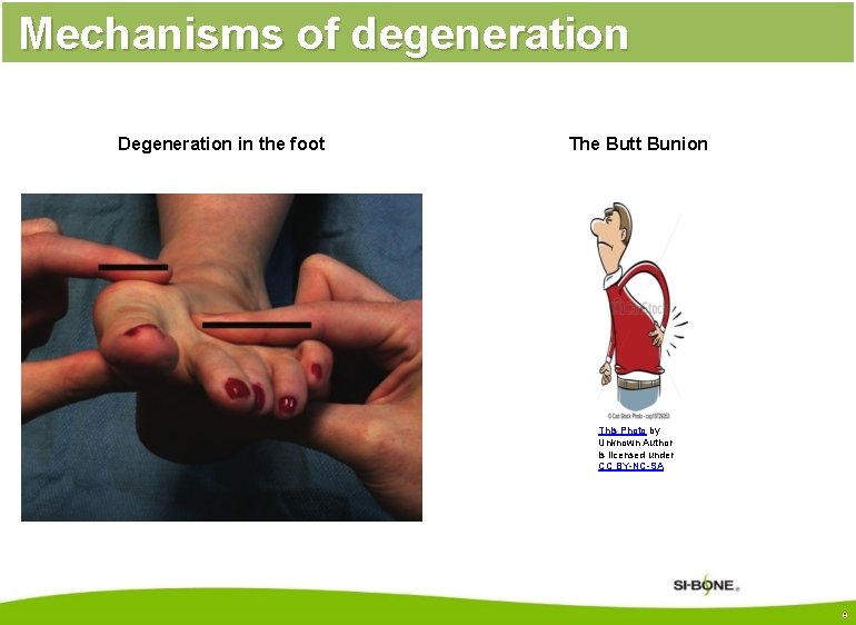 Mechanisms of degeneration Degeneration in the foot The Butt Bunion This Photo by Unknown