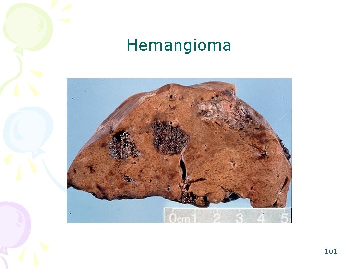 Hemangioma 101 