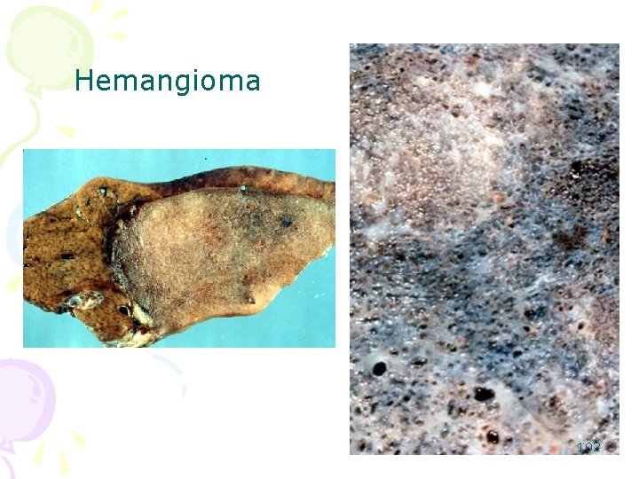 Hemangioma 102 