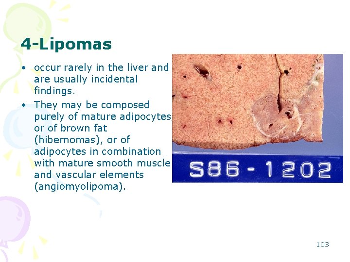 4 -Lipomas • occur rarely in the liver and are usually incidental findings. •