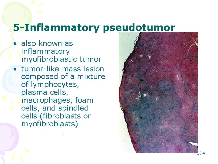 5 -Inflammatory pseudotumor • also known as inflammatory myofibroblastic tumor • tumor-like mass lesion
