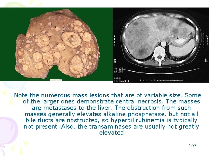 Note the numerous mass lesions that are of variable size. Some of the larger