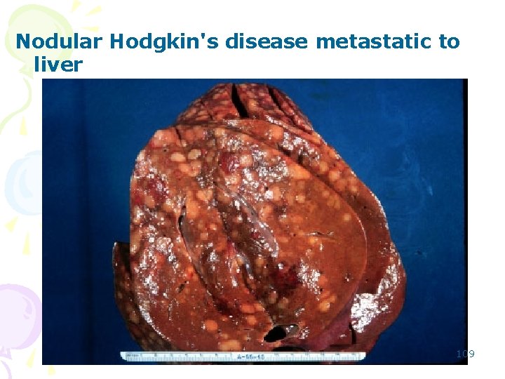 Nodular Hodgkin's disease metastatic to liver 109 
