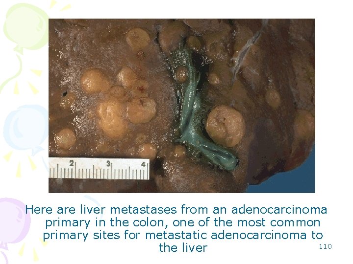 Here are liver metastases from an adenocarcinoma primary in the colon, one of the
