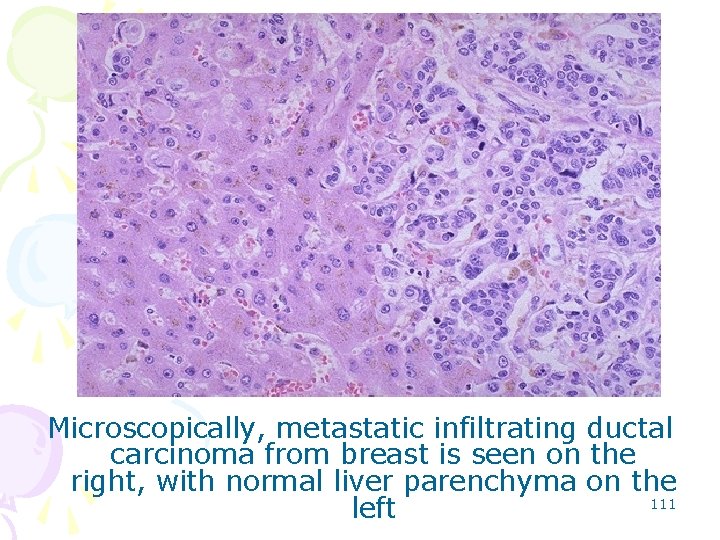 Microscopically, metastatic infiltrating ductal carcinoma from breast is seen on the right, with normal