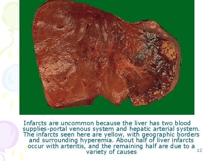 Infarcts are uncommon because the liver has two blood supplies-portal venous system and hepatic