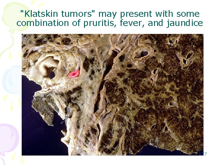"Klatskin tumors" may present with some combination of pruritis, fever, and jaundice 127 