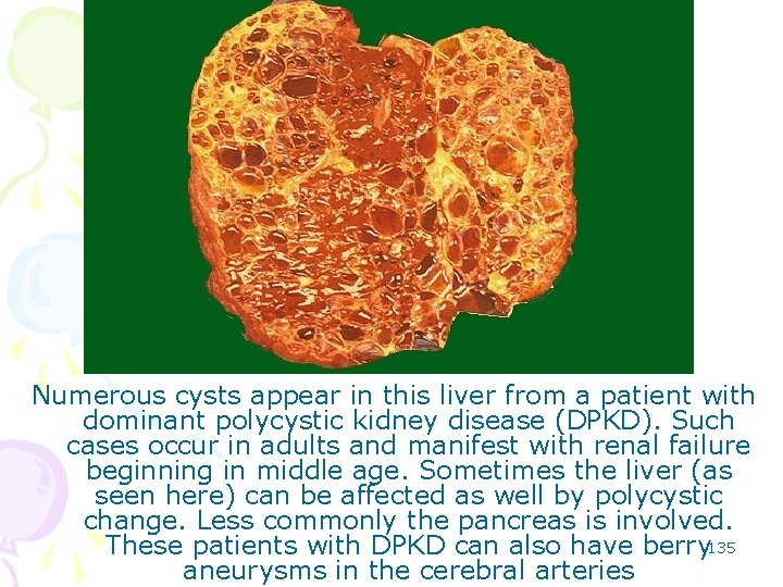 Numerous cysts appear in this liver from a patient with dominant polycystic kidney disease