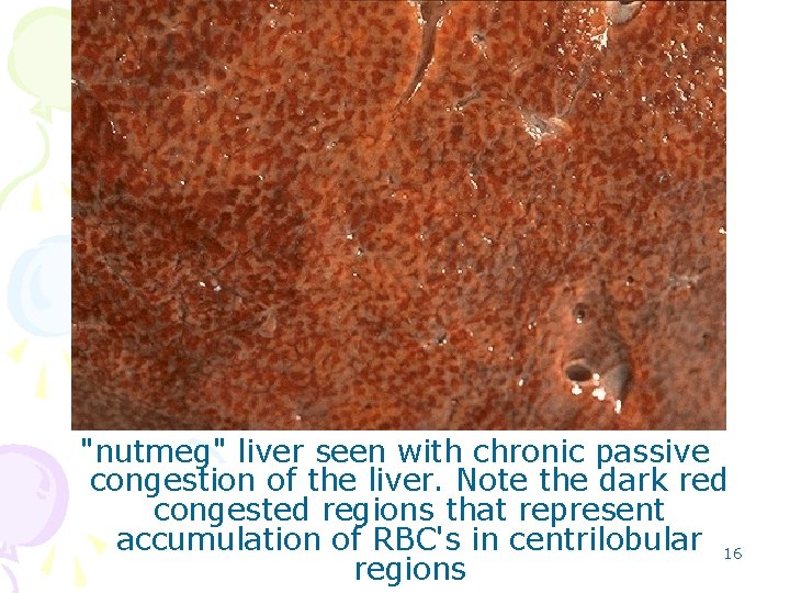 "nutmeg" liver seen with chronic passive congestion of the liver. Note the dark red