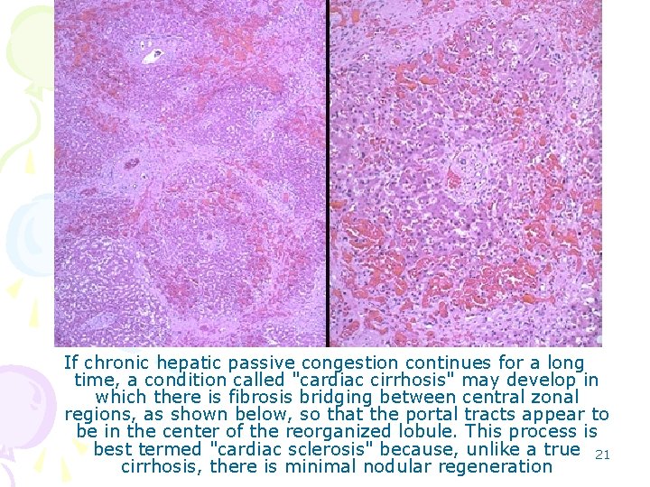 If chronic hepatic passive congestion continues for a long time, a condition called "cardiac