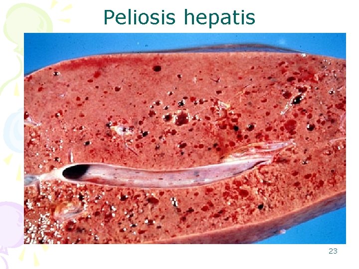 Peliosis hepatis 23 