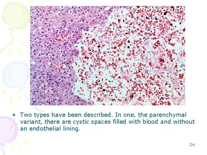  • Two types have been described. In one, the parenchymal variant, there are