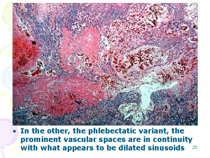  • In the other, the phlebectatic variant, the prominent vascular spaces are in