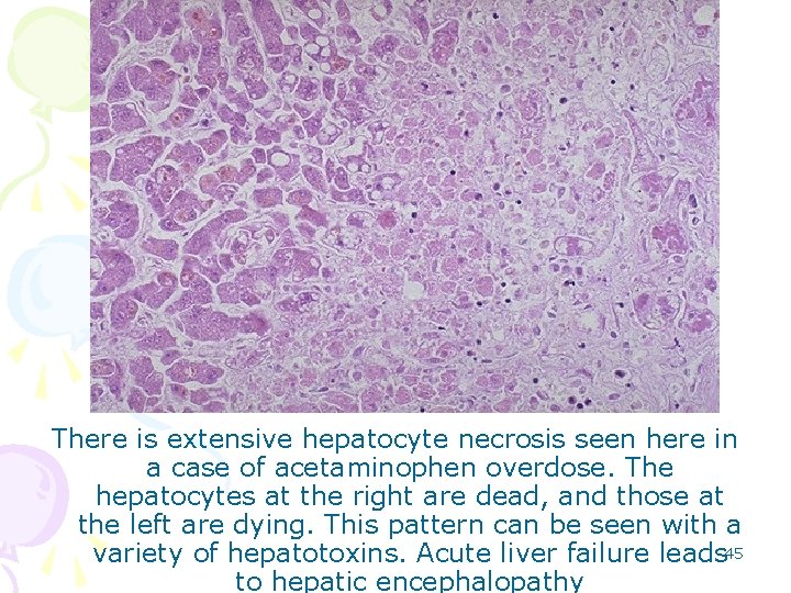 There is extensive hepatocyte necrosis seen here in a case of acetaminophen overdose. The