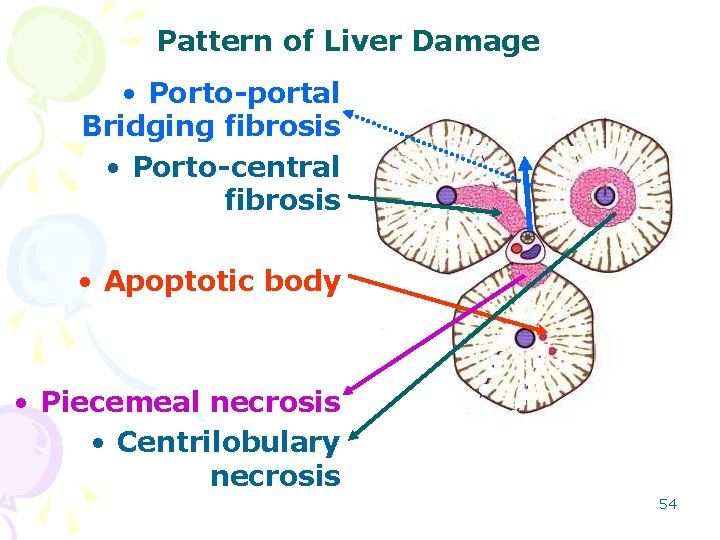 Pattern of Liver Damage • Porto-portal Bridging fibrosis • Porto-central fibrosis • Apoptotic body