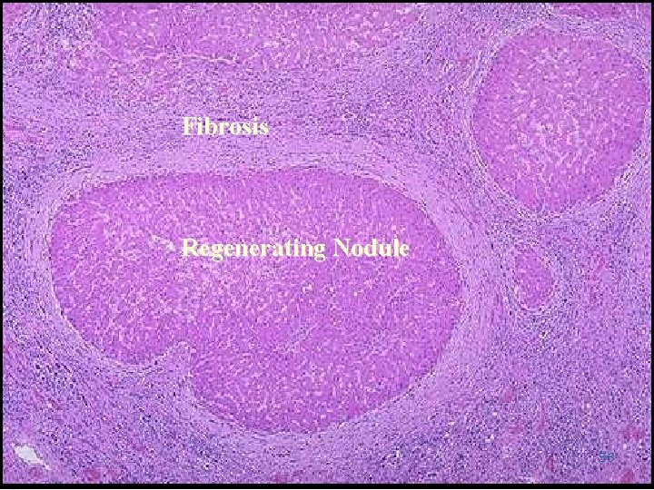 Fibrosis Regenerating Nodule 56 