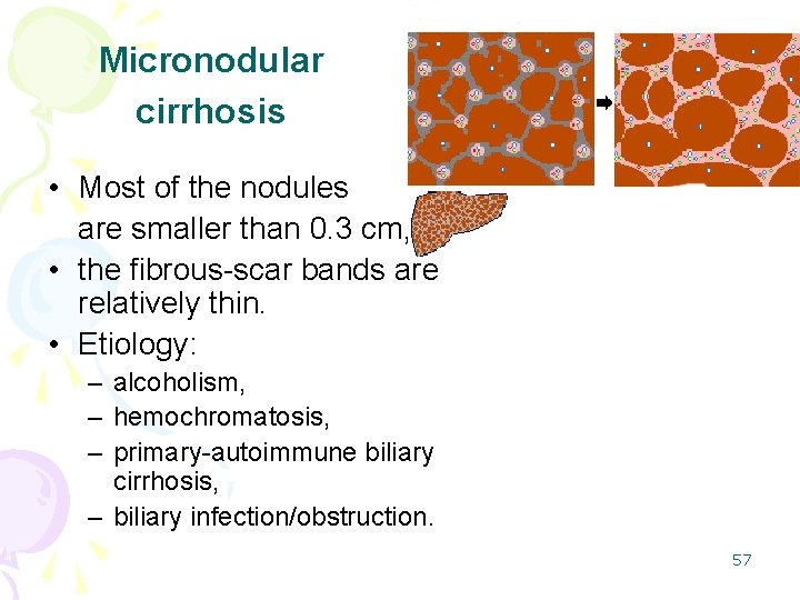 Micronodular cirrhosis • Most of the nodules are smaller than 0. 3 cm, •
