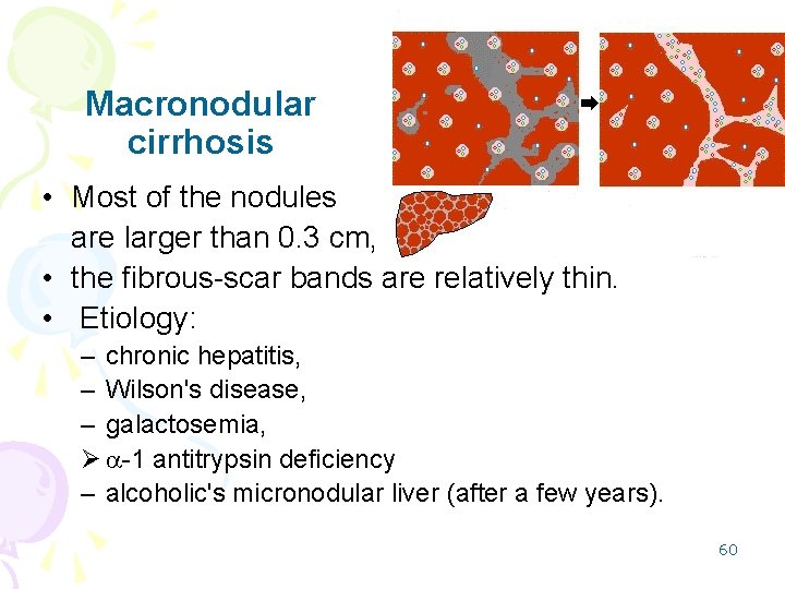 Macronodular cirrhosis • Most of the nodules are larger than 0. 3 cm, •