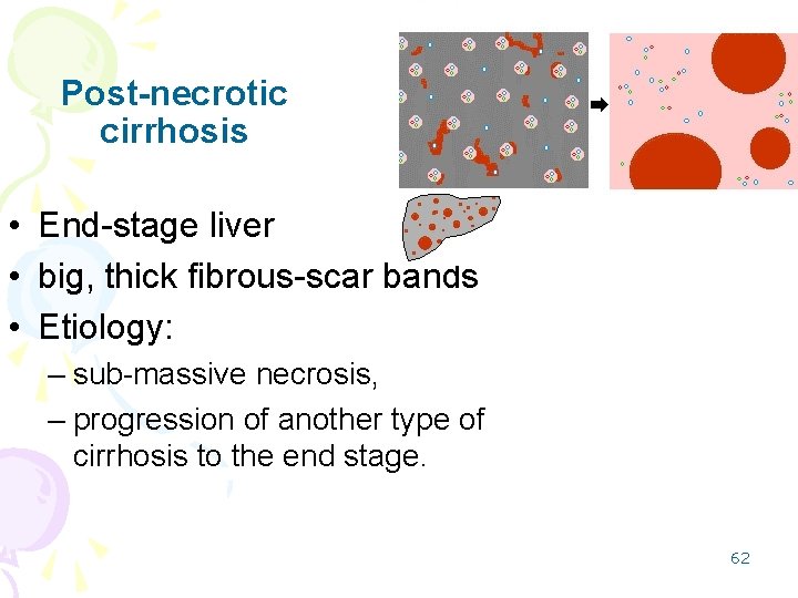 Post-necrotic cirrhosis • End-stage liver • big, thick fibrous-scar bands • Etiology: – sub-massive