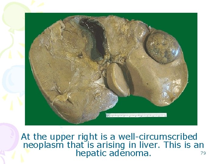 At the upper right is a well-circumscribed neoplasm that is arising in liver. This