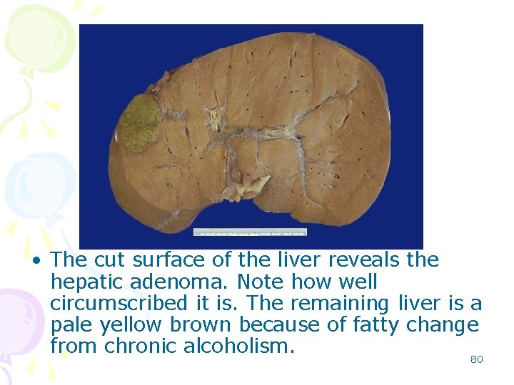  • The cut surface of the liver reveals the hepatic adenoma. Note how