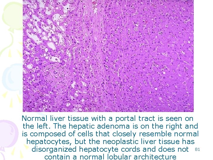 Normal liver tissue with a portal tract is seen on the left. The hepatic