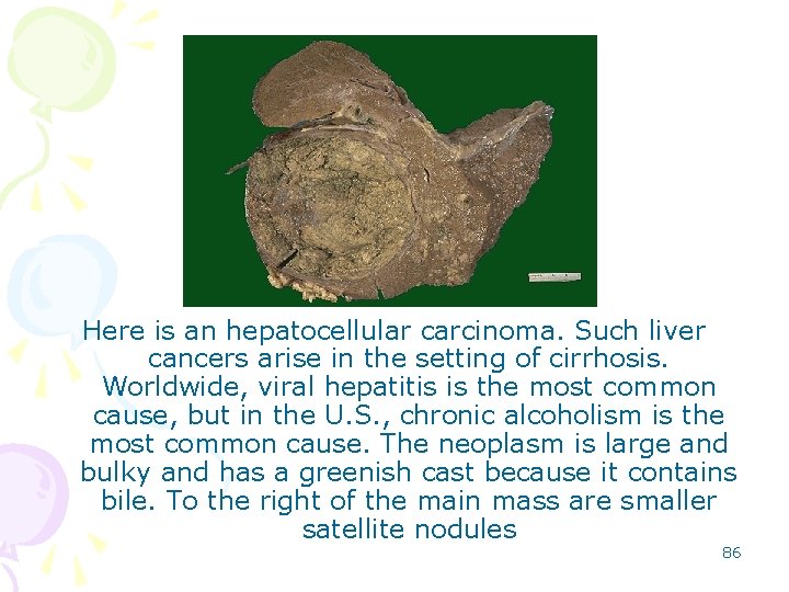 Here is an hepatocellular carcinoma. Such liver cancers arise in the setting of cirrhosis.