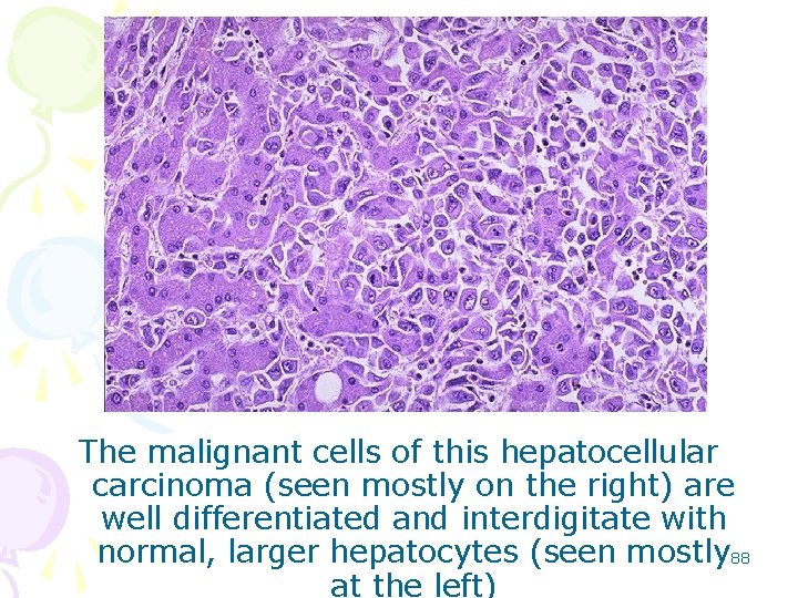 The malignant cells of this hepatocellular carcinoma (seen mostly on the right) are well