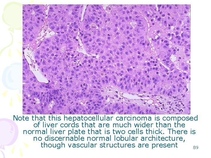 Note that this hepatocellular carcinoma is composed of liver cords that are much wider