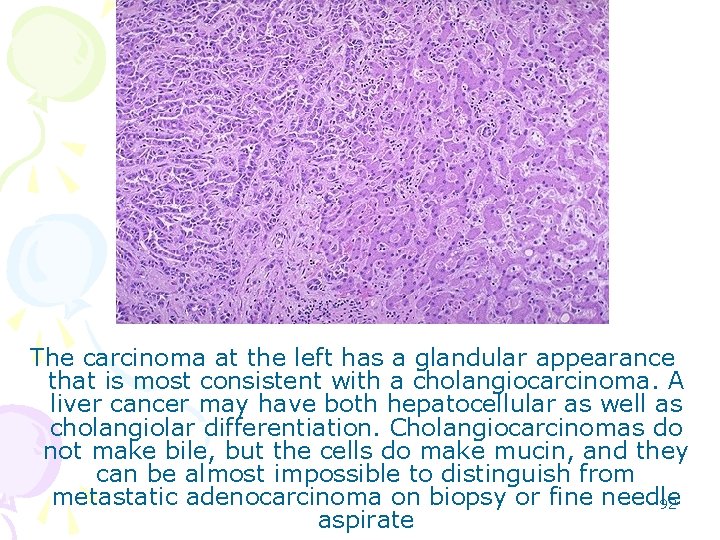 The carcinoma at the left has a glandular appearance that is most consistent with
