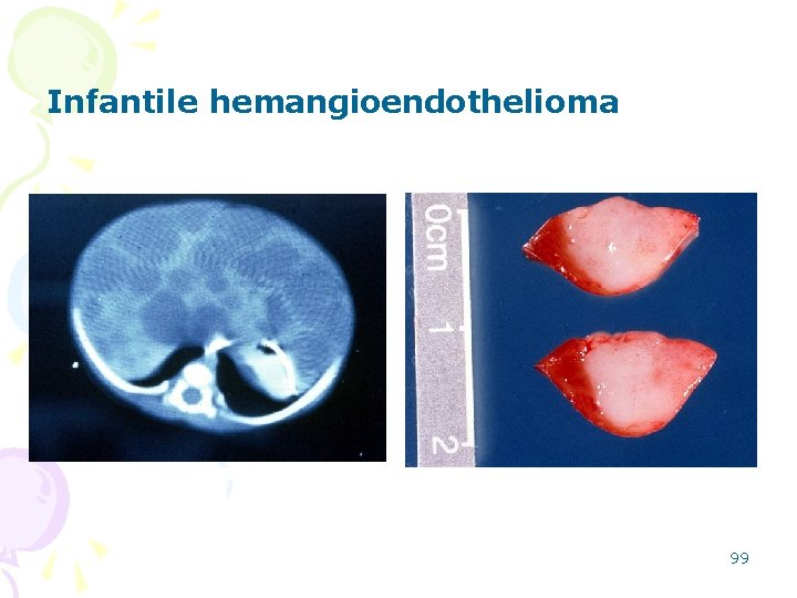 Infantile hemangioendothelioma 99 