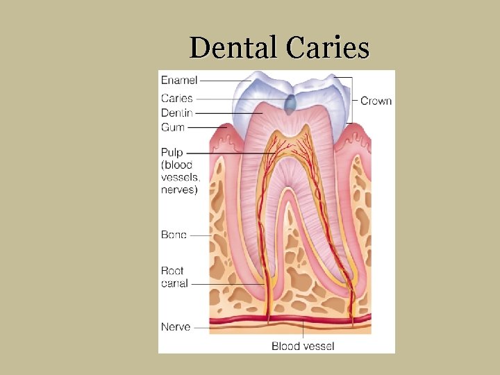 Dental Caries 