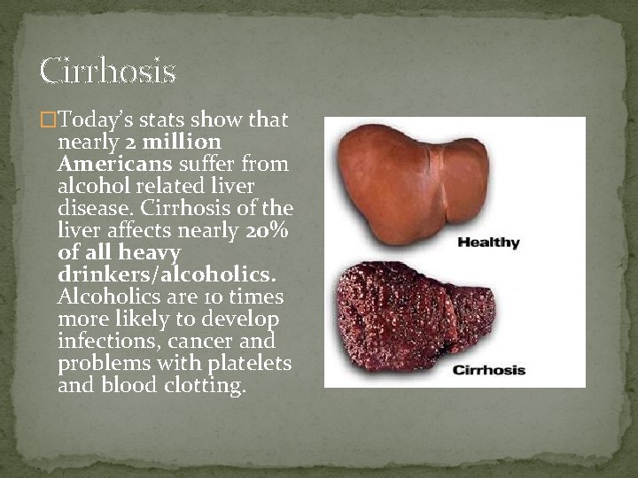 Cirrhosis �Today’s stats show that nearly 2 million Americans suffer from alcohol related liver