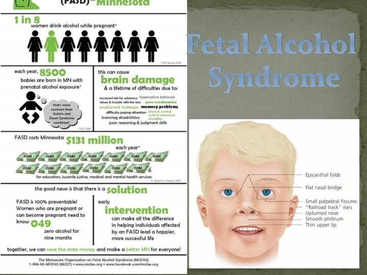 Fetal Alcohol Syndrome 